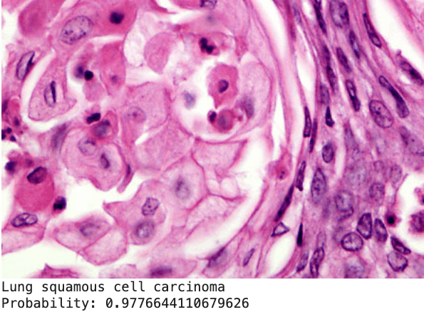 Lung Tumor Classifier - ML image classifier for early lung-cancer detection. Built with Python, PyTorch, Scikit-Learn, Streamlit.